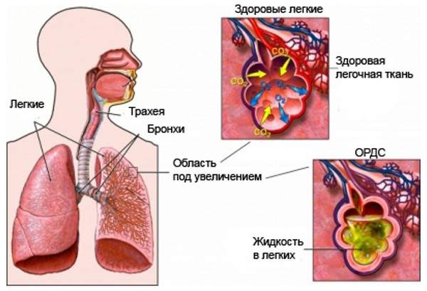 алгоритм оказания неотложной помощи на догоспитальном этапе при отеке легких