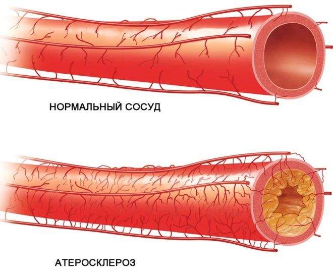 атеросклероз нижних конечностей отек стопы трофическая язва чем лечить