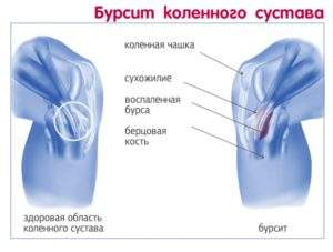 боль под коленной чашечкой без отека и припухлости лечение