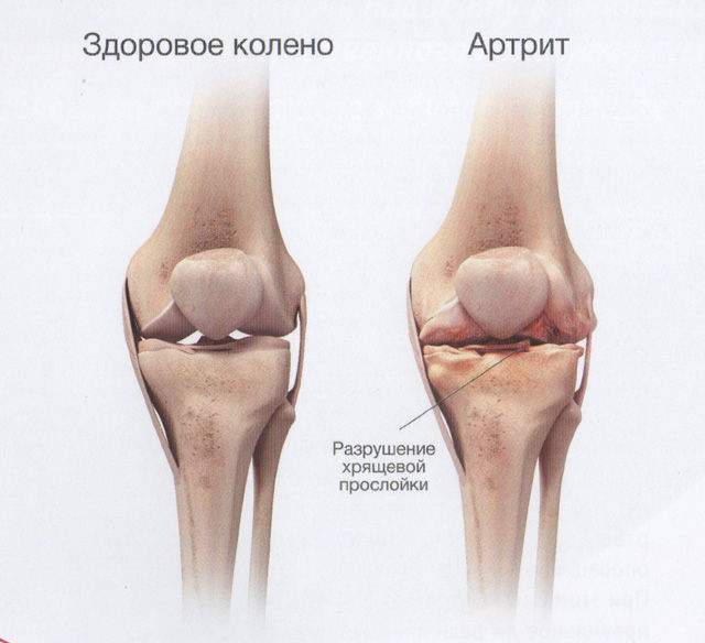 боль сзади коленки при ходьбе нога не разгибается ушиба нет