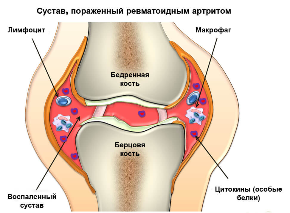 боль в голеностопе при ходьбе без отека и припухлости лечение