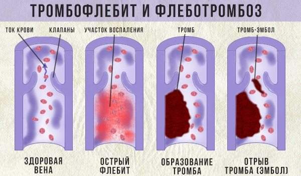 боль в голеностопе при ходьбе без отека и припухлости лечение