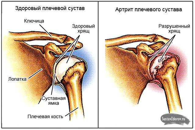 болит плечо после ушиба при поднятии руки вверх лечение