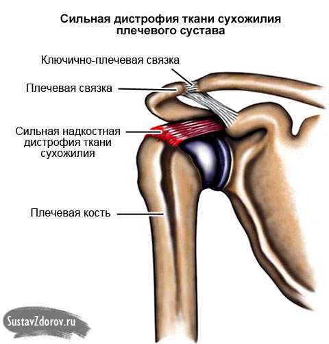 болит плечо после ушиба при поднятии руки вверх лечение