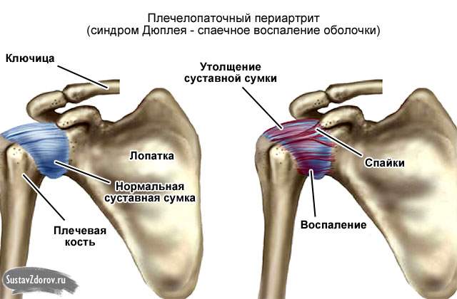 болит плечо после ушиба при поднятии руки вверх лечение