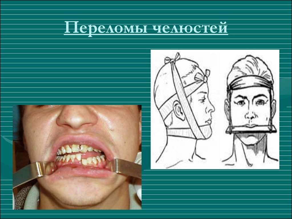 челюсть не открывается до конца после перелома