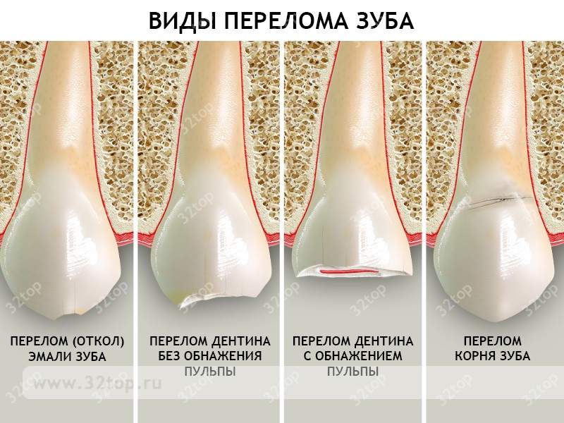 челюсть не открывается до конца после перелома