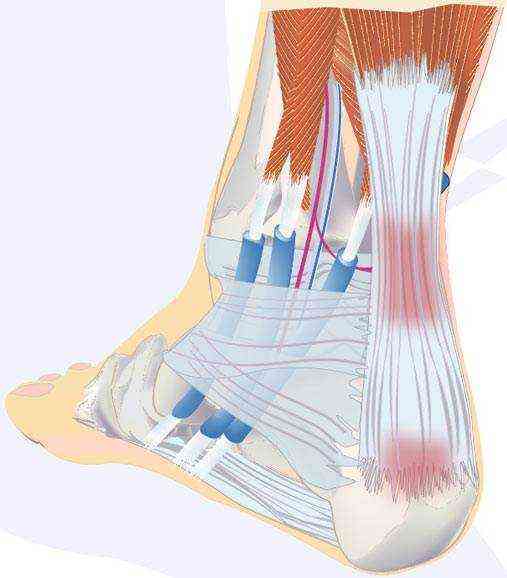 чем лечить воспаление пятки ахиллесова пята после сильнейшего вывиха