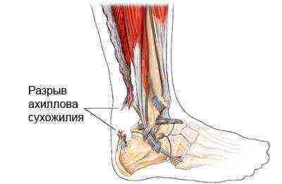 чем лечить воспаление пятки ахиллесова пята после сильнейшего вывиха