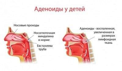 чем снять отек слизистой носа у ребенка при аденоидах