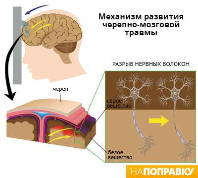 через сколько можно заниматься спортом после ушиба головы