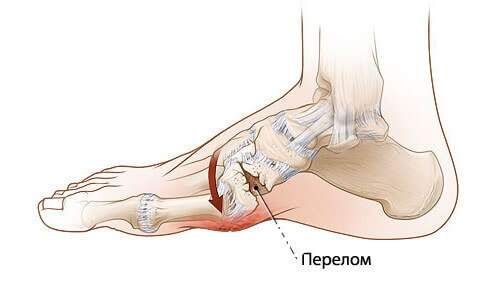 что будет если не лечить перелом стопы