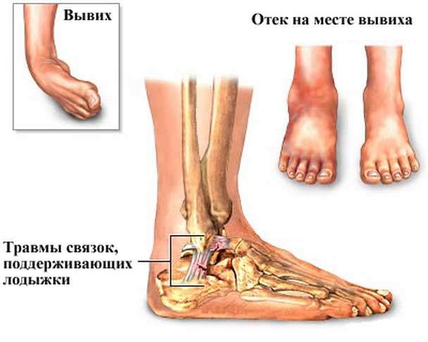 что делать при вывихе лодыжки в домашних условиях