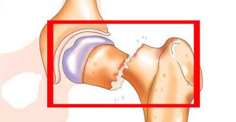что нужно пить при переломе шейки бедра