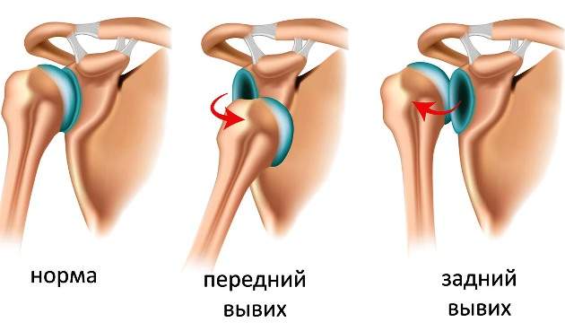 что такое вывихи суставов и их симптомы и лечение