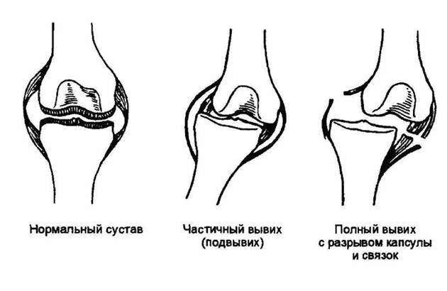 что такое вывихи суставов и их симптомы и лечение