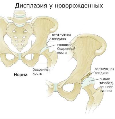 двухсторонний вывих тазобедренных суставов у новорожденных