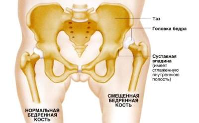 двухсторонний вывих тазобедренных суставов у новорожденных