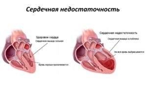 если пить мочегонные каждый день при отеках что будет