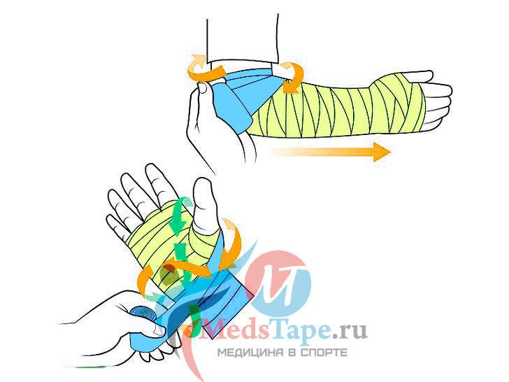 как наматывать эластичный бинт на руку при ушибе