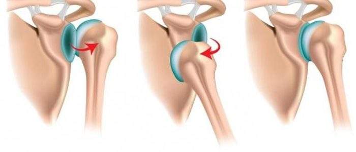 как оказать первую медицинскую помощь при вывихе плечевого сустава