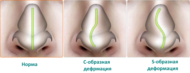 как снять опухоль с носа после ушиба