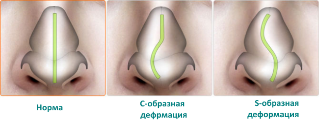 как снять отек носа у ребенка при ушибе