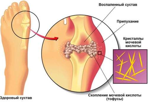 как снять отек с ноги в домашних условиях при подагре