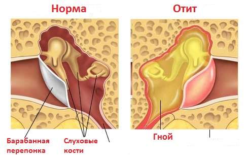 как снять отек уха при отите в домашних условиях