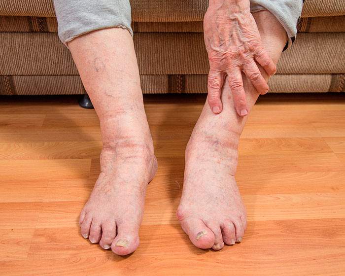 как вылечить отеки ног у пожилого человека в домашних условиях