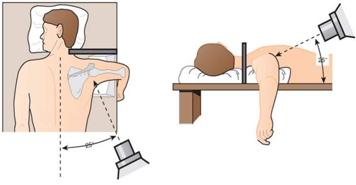 как вылечить привычный вывих плечевого сустава без операции