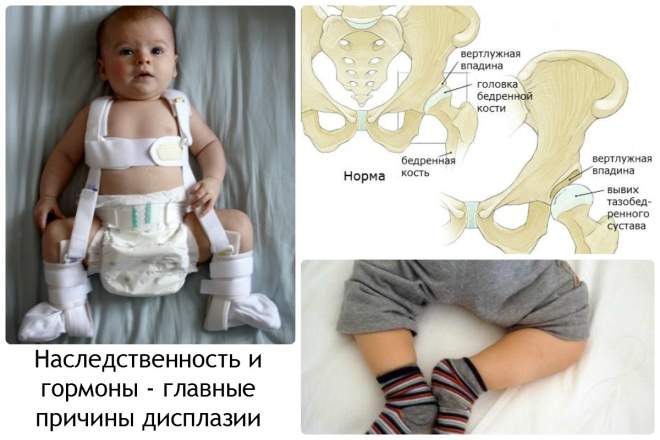 лечение врожденного вывиха тазобедренного сустава у детей