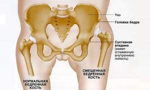 лечения вывихов тазобедренных суставов у детей после года