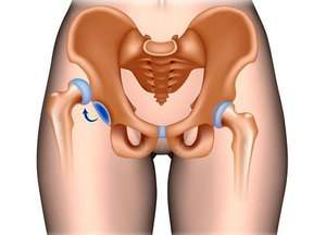 лечения вывихов тазобедренных суставов у детей после года