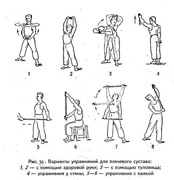 лфк после снятия гипса при вывихе плеча