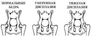 массаж при вывихе тазобедренного сустава у взрослых