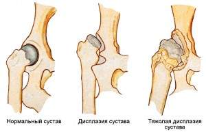 массаж при вывихе тазобедренного сустава у взрослых