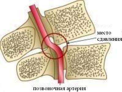 могут ли быть отеки под глазами при остеохондрозе шейного отдела