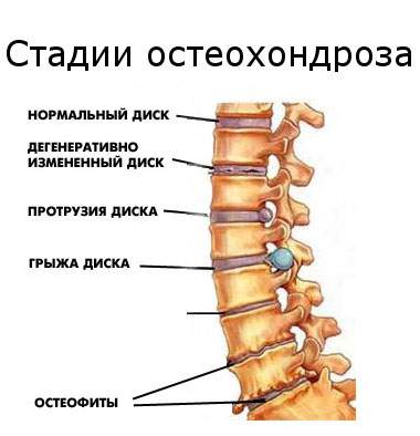 могут ли быть отеки под глазами при остеохондрозе шейного отдела