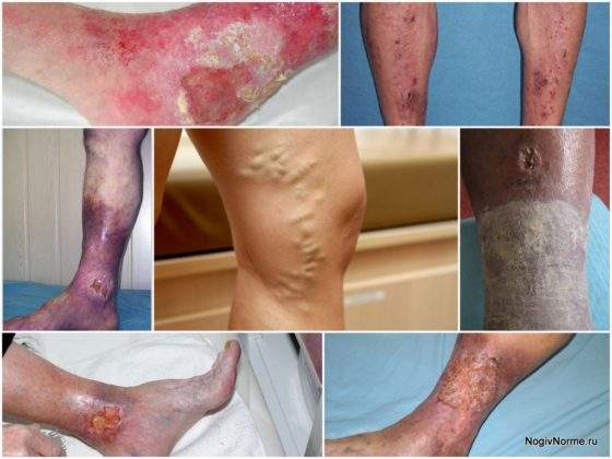 мокнущие раны на ногах лечение при варикозе и отеках