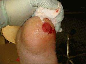 мокнущие раны на ногах лечение при варикозе и отеках