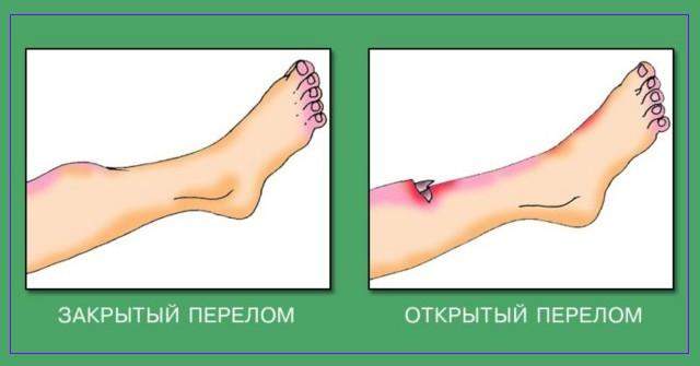 можно ли ходить в баню с ушибом ребра