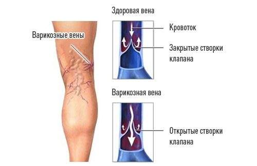 можно ли использовать эластичный бинт при вывихе