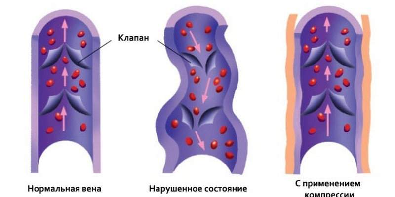 можно ли носить компрессионные чулки при отеках ног беременным