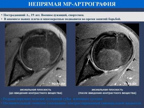 операция латарже на плечевом суставе привычный вывих