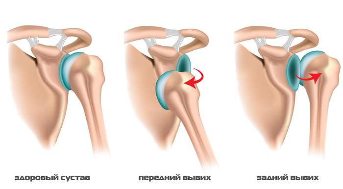 операция розенштейна при привычном вывихе плеча