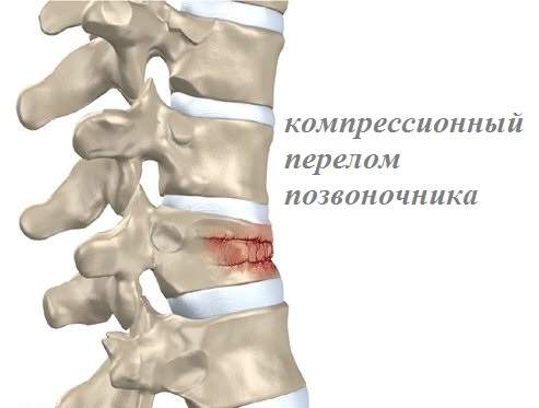 осложнения после компрессионного перелома позвоночника поясничного отдела