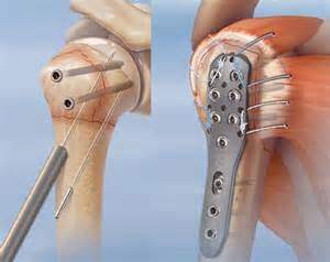 остеосинтез перелома диафиза плечевой кости блокируемым стержнем