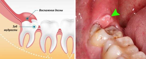 отек десны возле зуба мудрости что делать в домашних условиях