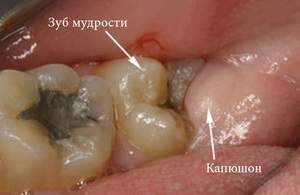 отек десны возле зуба мудрости что делать в домашних условиях